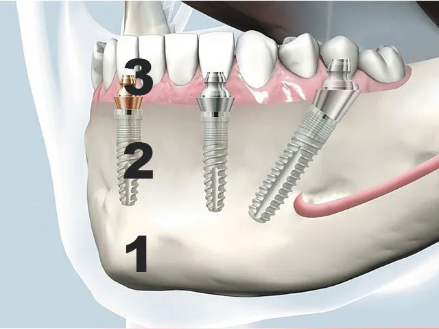 Implant dentar