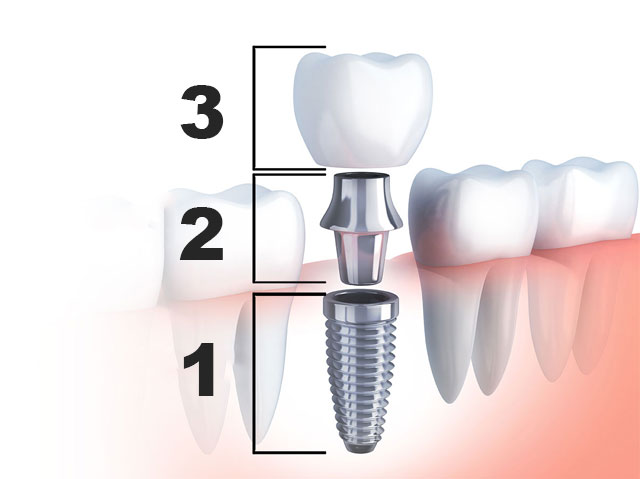 Implant dentar